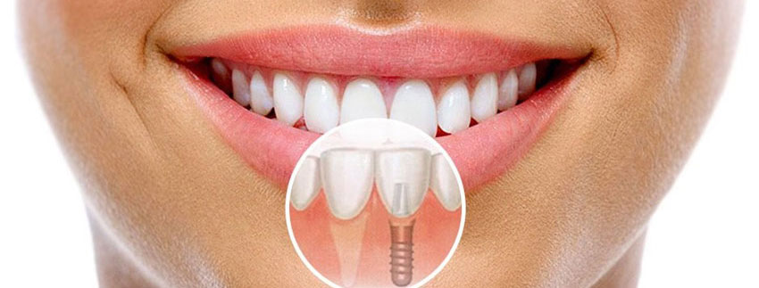 dentalnaya implantaciya